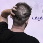 أسرع علاج للشعر الخفيف بدون تدخل جراحي : 42 يوم 10 أسرع علاج للشعر الخفيف بريمادار للنساء و للرجال