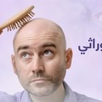 علاجات الصلع الوراثي : فى 6 اشهر فقط مع بريمادار