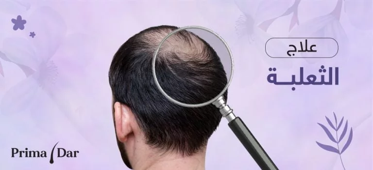 علاج الثعلبة في الشعر : حسن صحة فروة رأسك وجمال شعرك