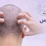 علاج التهابات فروة الرأس : وسائل التخلص من الحكة بريمادار