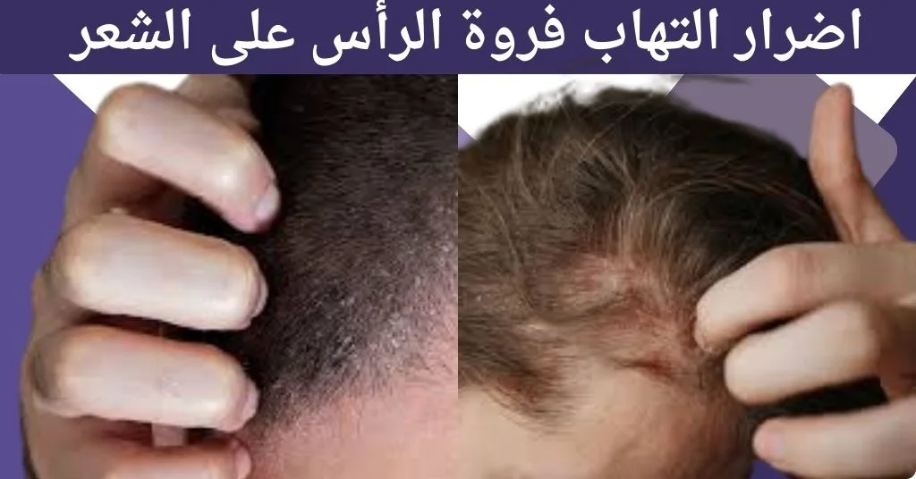 اضرار التهاب فروة الرأس على الشعر