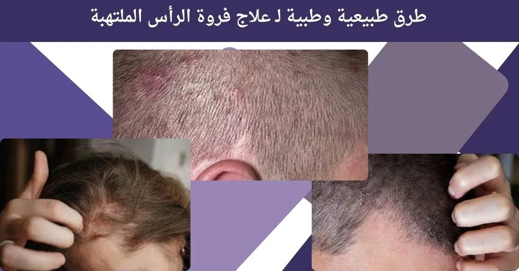 طرق طبيعية وطبية لـ علاج فروة الرأس الملتهبة