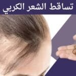 تساقط الشعر الكربي