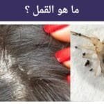ما هو القمل ؟ و شكل القمل الصغير ؟