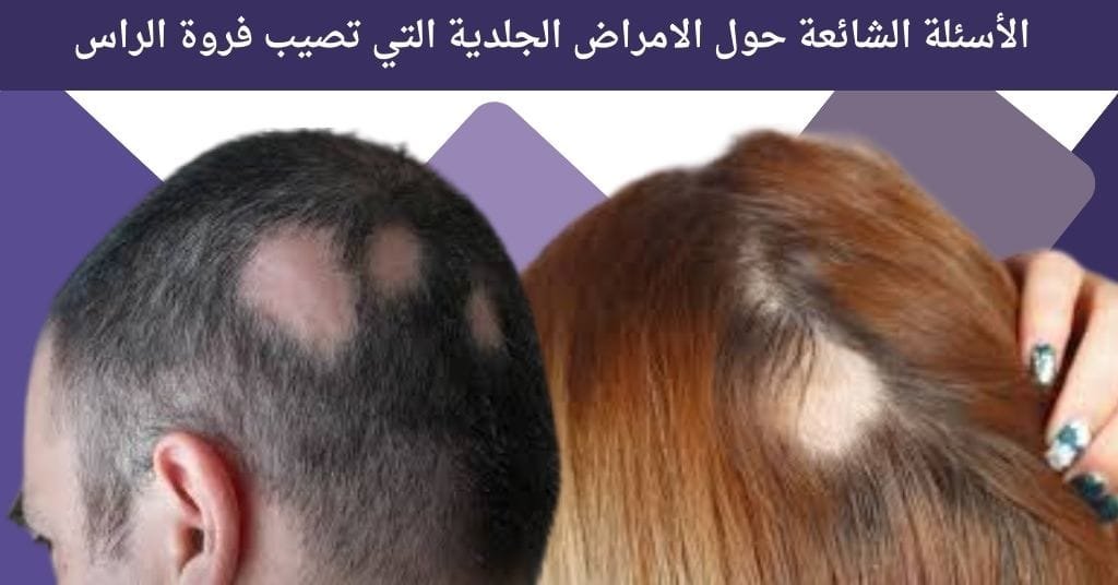 الأسئلة الشائعة حول الامراض الجلدية التي تصيب فروة الراس بالصور