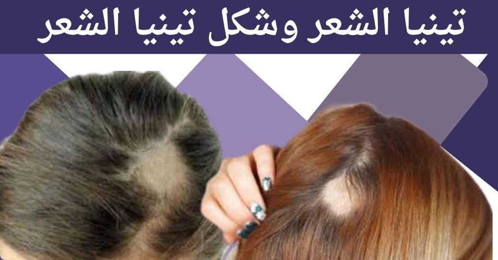 تينيا الشعر وشكل تينيا الشعر