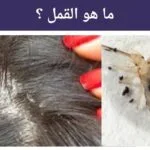 شكل القمل الصغير : 5 حقائق مدهشة وكيفية التخلص منه نهائيا 4 ما هو القمل ؟ و شكل القمل الصغير ؟