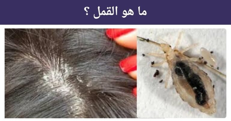ما هو القمل ؟ و شكل القمل الصغير ؟
