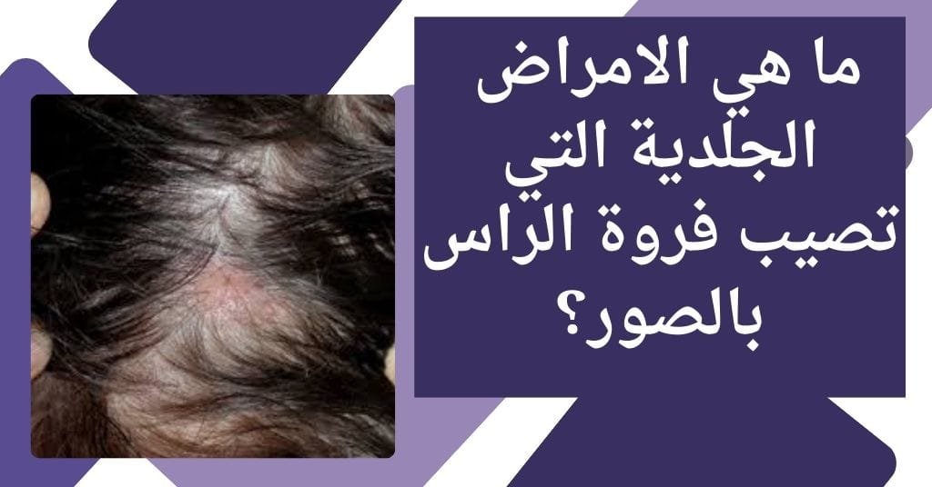 ما هي الامراض الجلدية التي تصيب فروة الراس بالصور؟