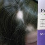 علاج الثعلبة من الصيدلية _ 7 فوائد فعّالة مع بريمادار