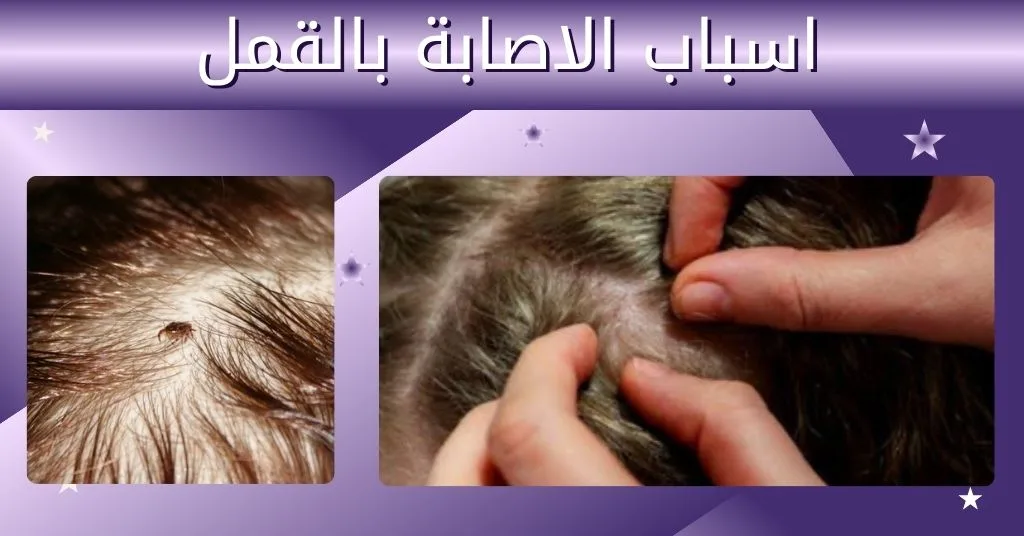 اسباب الاصابة بالقمل