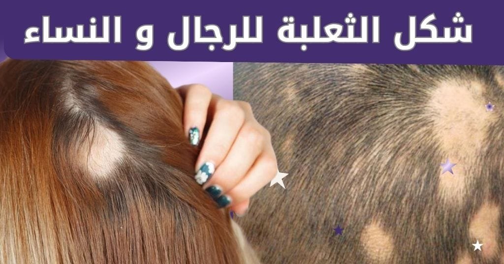 شكل الثعلبة للرجال و النساء