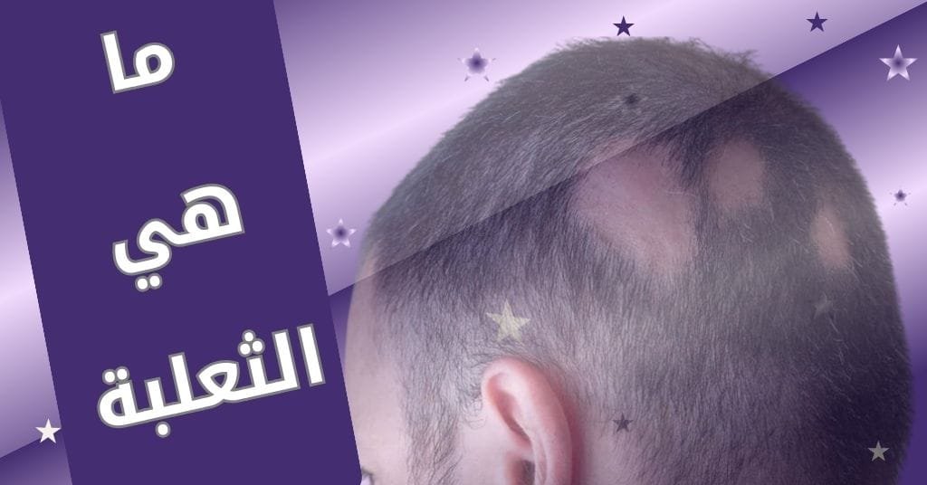 ما هي الثعلبة وما شكلها