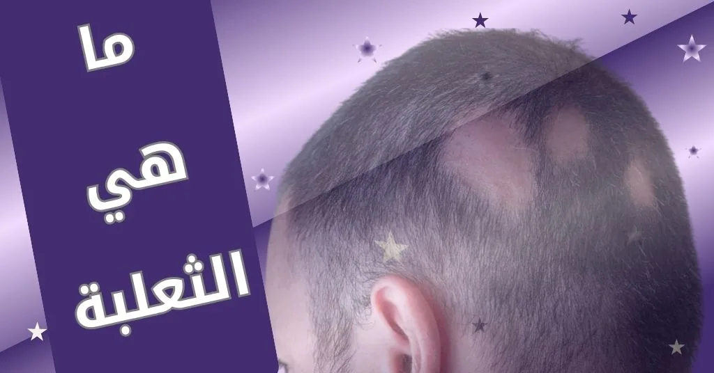 علاج الثعلبة من الصيدلية : 7 فوائد فعالة مع بريمادار 1 ما هي الثعلبة وما شكلها