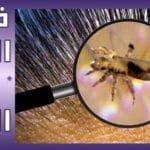 فوائد القمل في الشعر