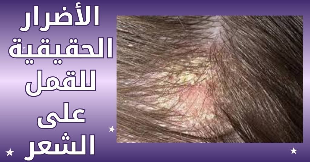 الأضرار الحقيقية للقمل على الشعر