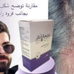 مقارنة توضح شكل صدفية الشعر بجانب فروة رأس صحية