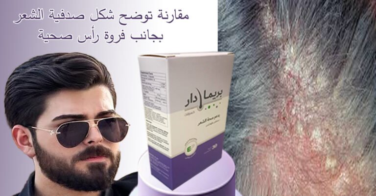 مقارنة توضح شكل صدفية الشعر بجانب فروة رأس صحية