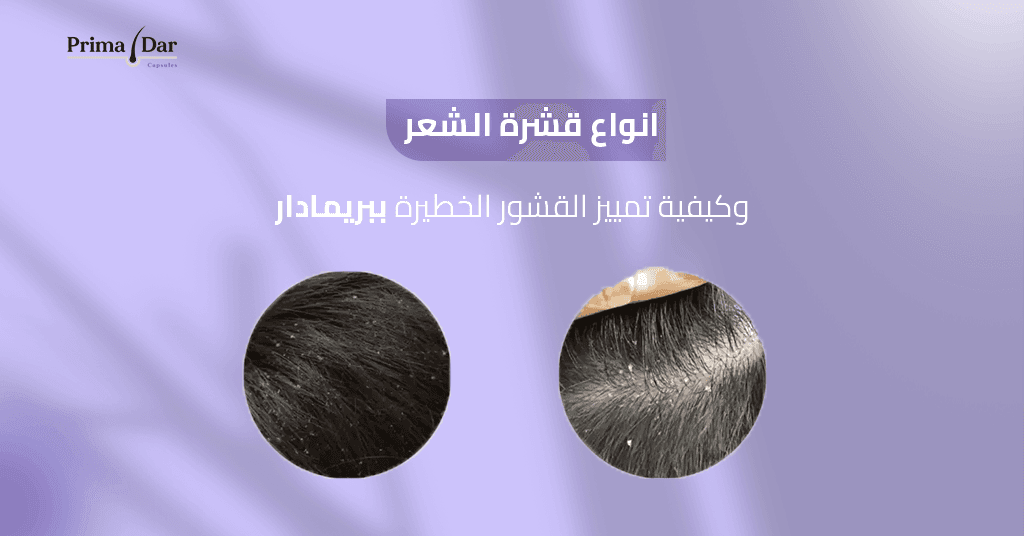 انواع قشرة الشعر بالصور وكيفية تمييز القشور الخطيرة ببريمادار