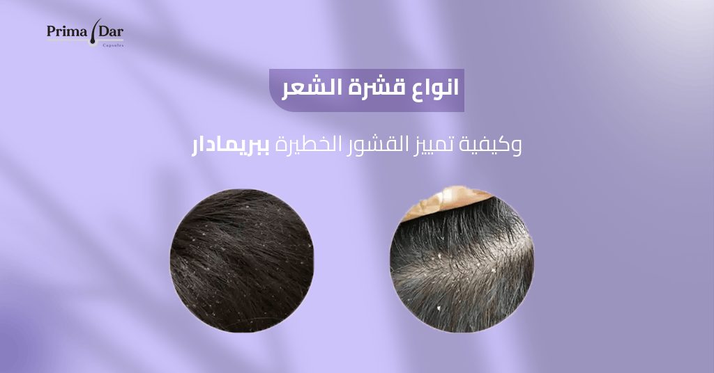 انواع قشرة الشعر بالصور وكيفية تمييز القشور الخطيرة ببريمادار